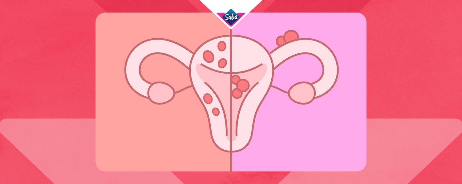 Imagen de adenomiosis y endometriosis representados en un dibujo