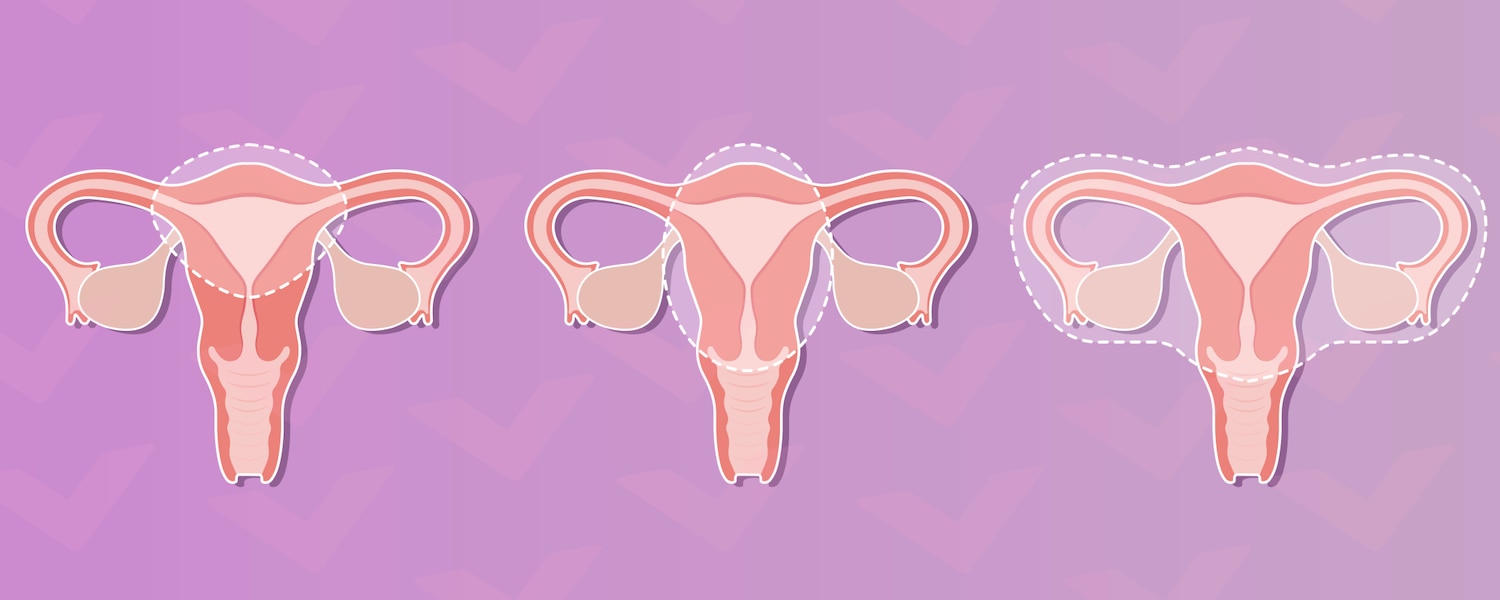 A close-up illustration of three uteruses, each depicting a different type of hysterectomy procedure