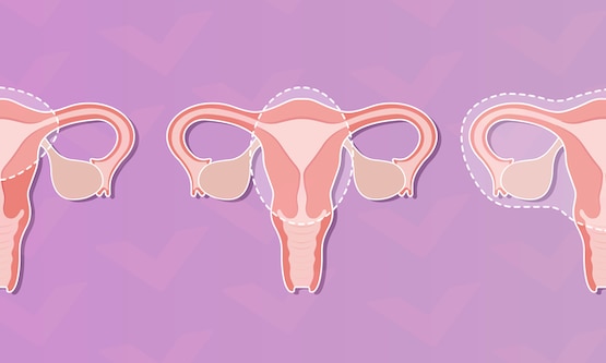 A close-up illustration of three uteruses, each depicting a different type of hysterectomy procedure