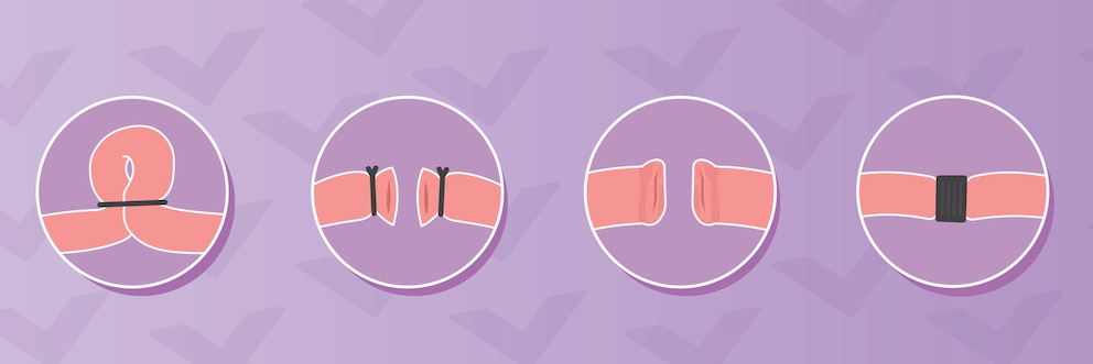 Illustration montrant les étapes d’une ligature des trompes.