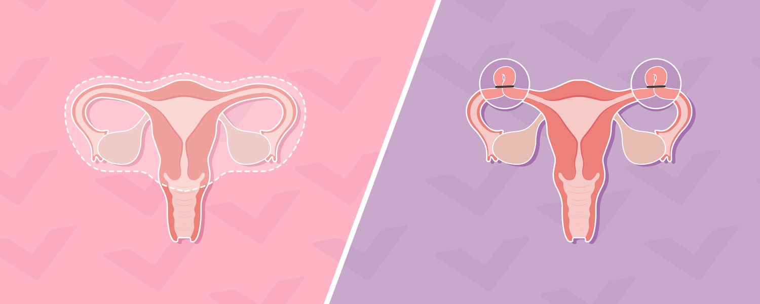 Hysterectomy Vs Tubal Ligation Whats The Difference