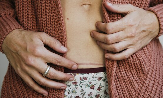 Woman wearing cardigan and underwear showing a caesarean scar on her belly.