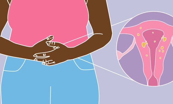 A woman with her arms holding her belly as if she is in pain. A zoomed-in cross-section of the woman’s uterus that shows where the adenomyosis is growing.