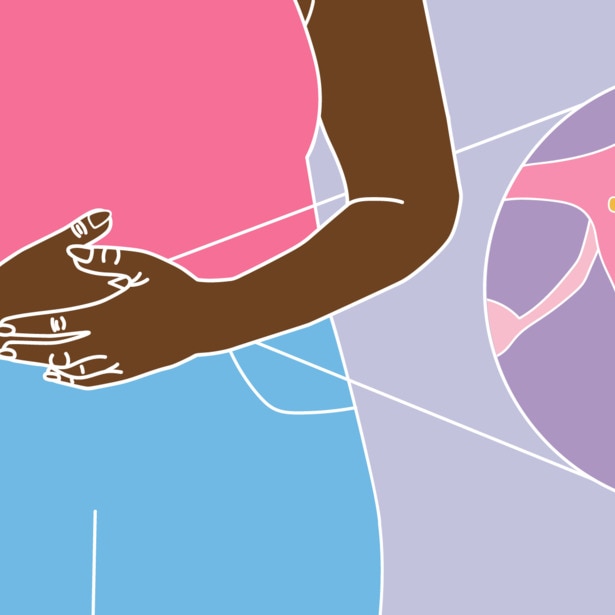 A woman with her arms holding her belly as if she is in pain. A zoomed-in cross-section of the woman’s uterus that shows where the adenomyosis is growing.