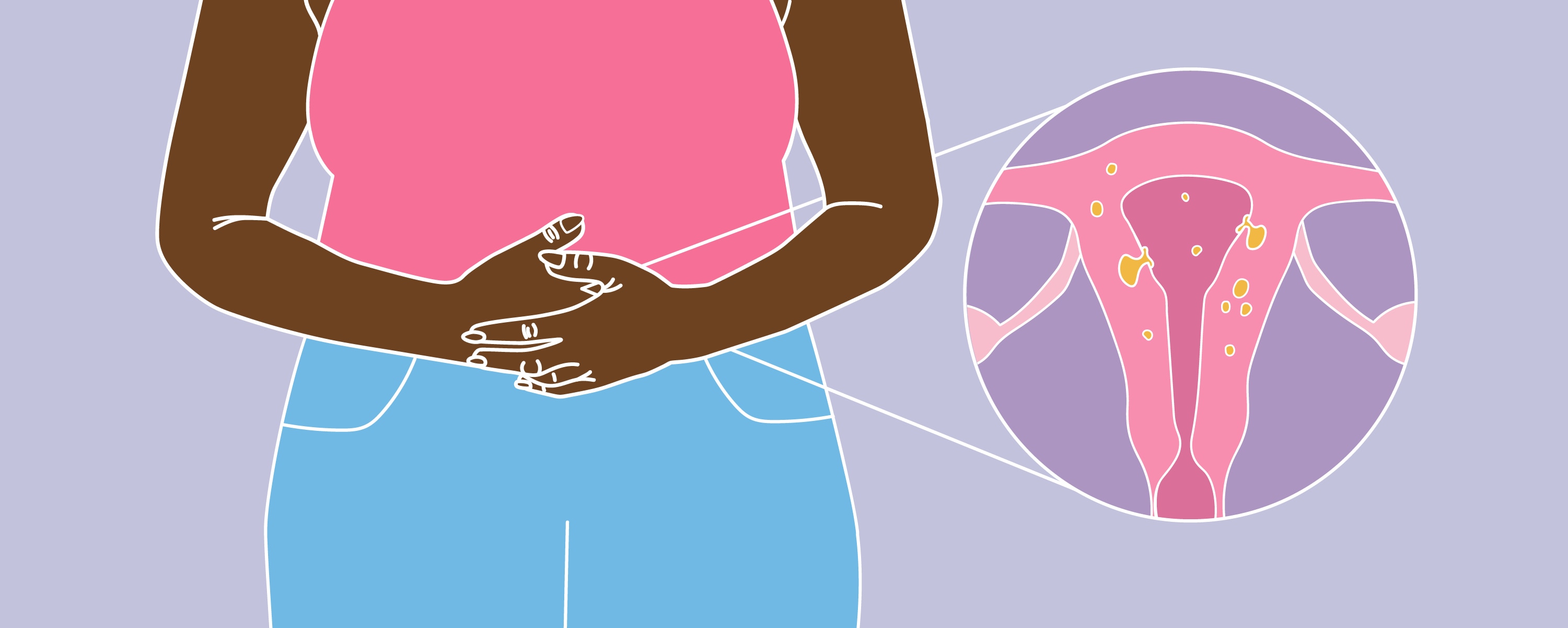 The image presents a visual representation relating to women's health, specifically focusing on the uterus and potential issues within it.