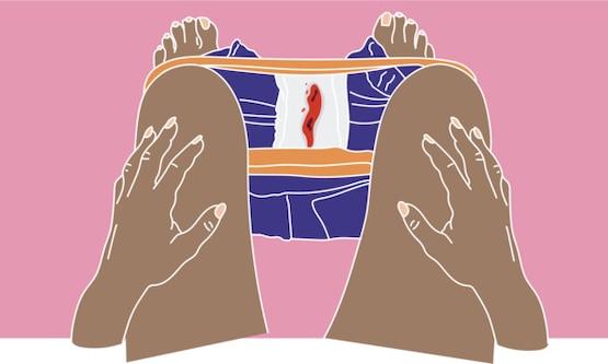 Assorbente con sangue dovuto a un aborto spontaneo