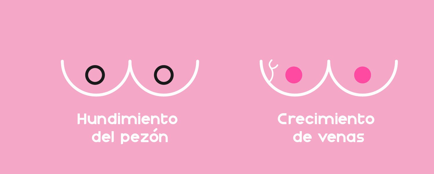 Imagen explicando los sintomas de hundimiento de pezón y crecimiento de venas sobre fondo color rosa - Saba