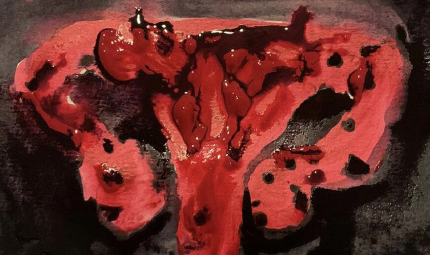 Illustration of an inflamed uterus