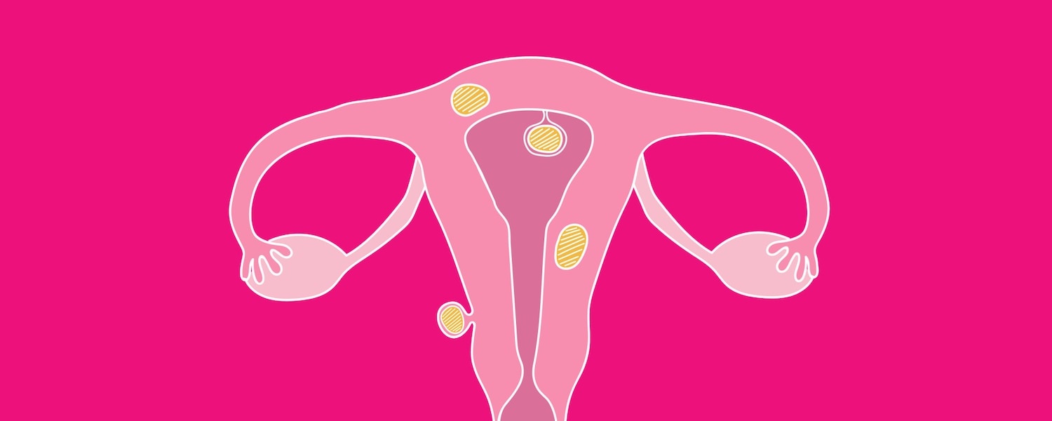 Uterus with fibroids growing on various areas