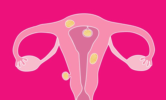 Uterus with fibroids growing on various areas