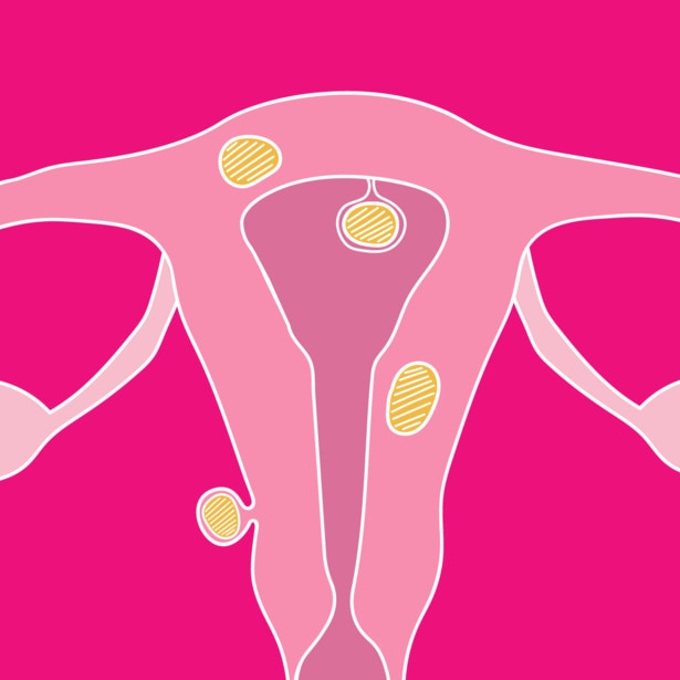 Uterus with fibroids growing in various areas.